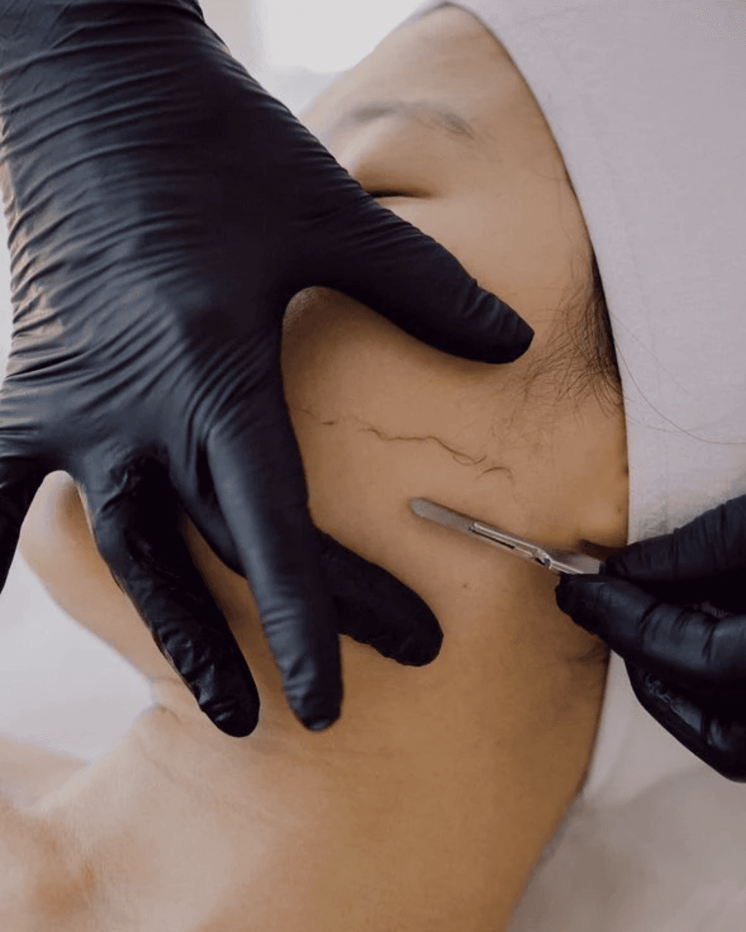 Dermaplaning treatment to remove peach fuzz and exfoliate skin.