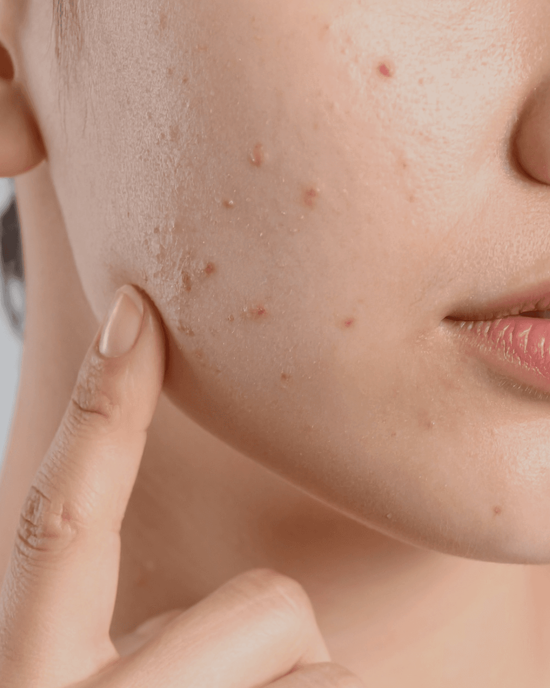 Skin Purging: What Is It